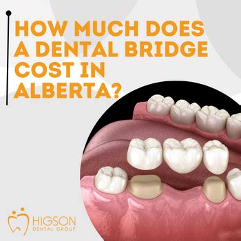 How Much Do Dental Bridges Cost In Alberta BEST Dental Bridge Cost