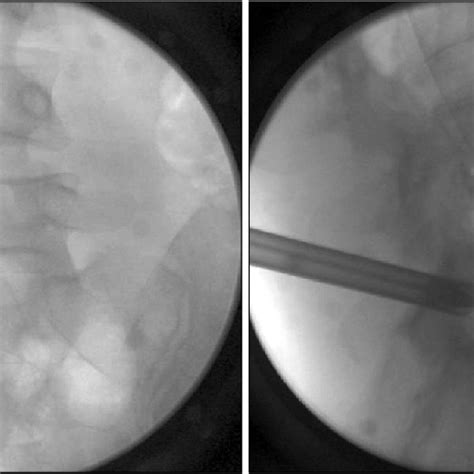 Intraoperative Fluoroscopic Images Showing The Working Cannula In The