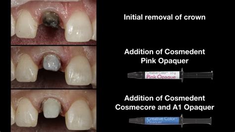 What Material Would You Choose To Mask A Dark Tooth CDOCS