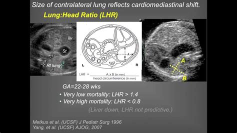 Diaphragmatic Hernia Ultrasound