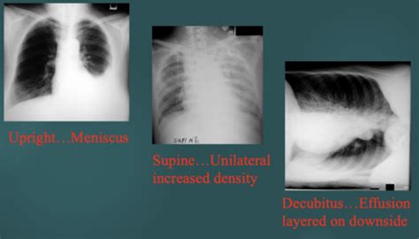 Pleural Effusion And Thoracentesis Flashcards Quizlet