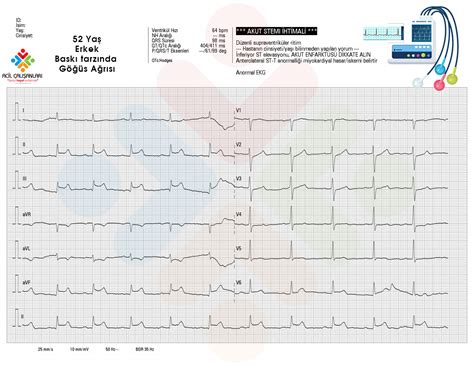 İnferior Miyokard İnfarktüsü Acil Çalışanları