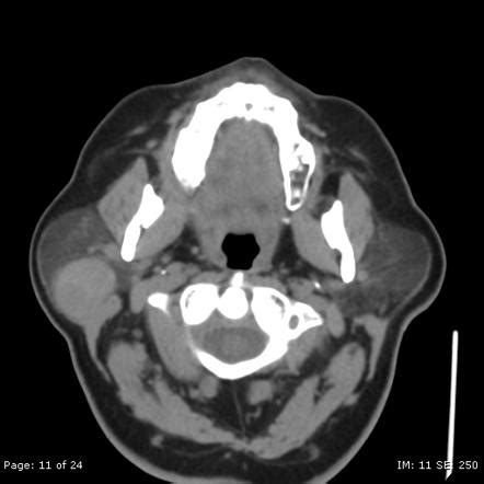 Pleomorphic Adenoma Of The Parotid Gland Radiology Case Radiopaedia Org