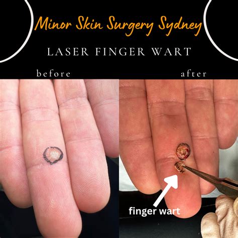 Laser Wart Removal Treatment Sydney Finger Warts Plantar Warts