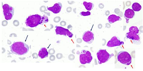 Full Text Granular Lymphoblast In A Case Of Acute Lymphoblastic Leukemia A Rare Morphology