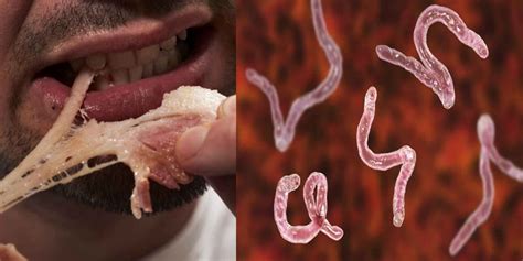 Mans Brain Chest Riddled With Over 700 Worms After Eating Undercooked Pork