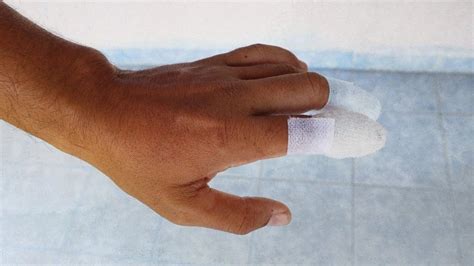 Cut Off Finger First Aid Treatment And Recovery