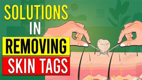 How To Remove Skin Tags Yourself Youtube