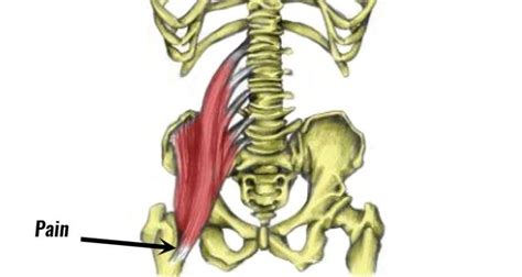 Iliopsoas Bursitis And Inflammation Symptoms Causes And Rehab