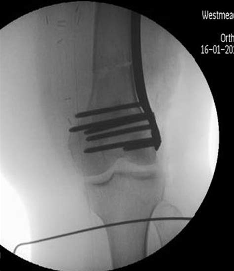 Iatrogenic Femur Fracture Following Medial Femoral Condyle Flap Harvest