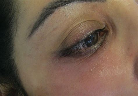 Laser Under Eye Vein Removal Solihull Medical Cosmetic Clinic