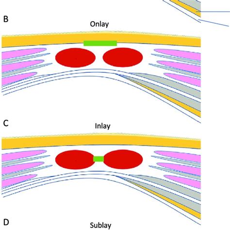 (PDF) Hernia Mesh and Hernia Repair: A Review