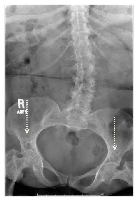 Osteomalacia A Year Old Female With Levoscoliosis And Heterogeneous