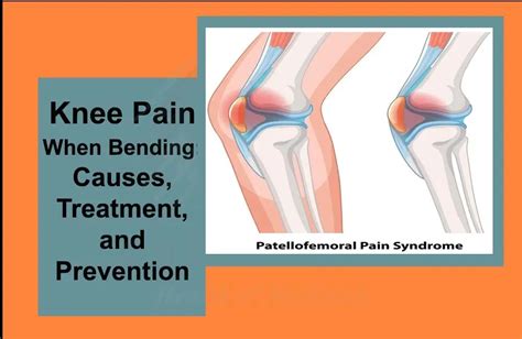 Knee Pain When Bending Causes Treatment And Prevention Curevigor