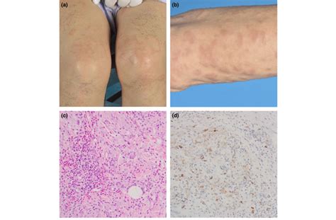 Clinical And Histopathological Manifestations A Arciform To Annular