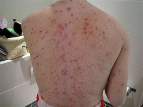 Adult Chicken Pox Look Like Telegraph