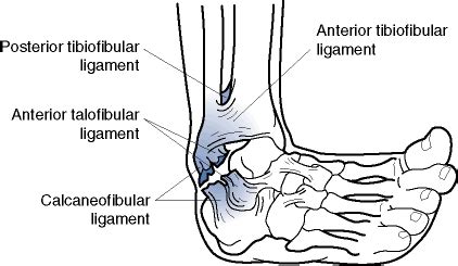 Preventing Ankle Injuries In Basketball | Glens Falls, Saratoga Springs