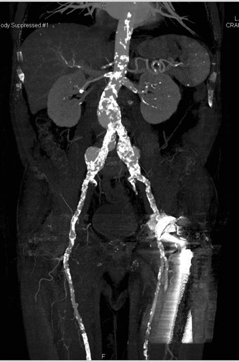 Extensive Vascular Calcification And Iliac Artery Aneurysms Vascular