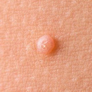 Molluscum Contagiosum Dermatologist In Santa Monica Ca Santa