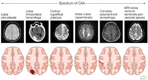 Figure 7 1 From Vascular Cognitive Impairment Semantic Scholar