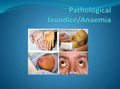 SOLUTION: Pathological jaundice - Studypool