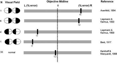 Figure 1 From Line Bisection As An Early Method To Assess Homonymous Hemianopia Semantic Scholar