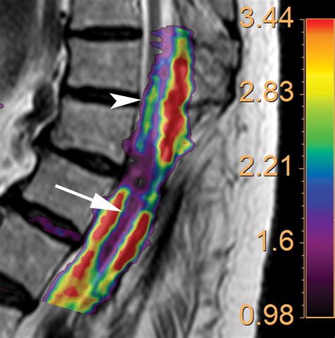 Optimizing Diffusion Tensor Imaging Acquisition For Spinal Cord