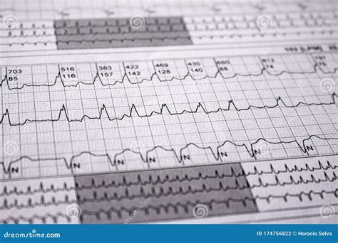 Electrocardiogram Strips With Cardiac Arrhythmias Alterations Of