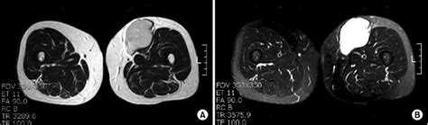 MRI images of the mass in the thigh. A MRI shows 6.6×5.5×4.7 cm sized... | Download Scientific ...