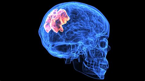 Aprende A Identificar La Embolia Cerebral Hospital De Especialidades Mig