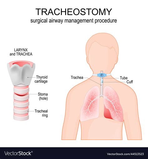 Tracheostomy Anatomy Of The Trachea With Stoma Vector Image