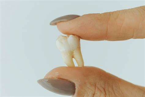 Decayed Tooth Extraction The Best Solution For Oral Health