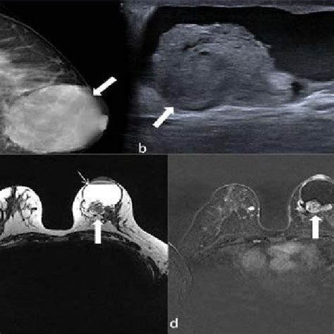 A Left Breast Mammography Craniocaudal Cc Views A Large Well