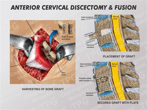 Acdf One Level Placement Of Bone Graft Order