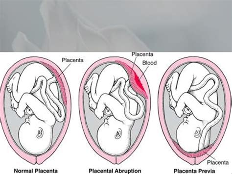 Abrupture Of Placenta Online Presentation