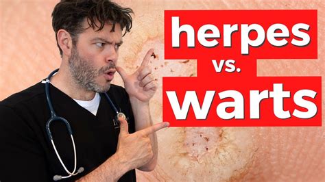 How To Tell Genital Herpes From Warts Youtube