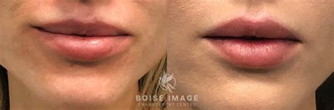 Dissolving Lip Filler Blog Boise Image Enhancement Centre