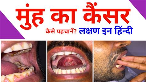 Lips Cancer Ke Lakshan Lipstutorial Org