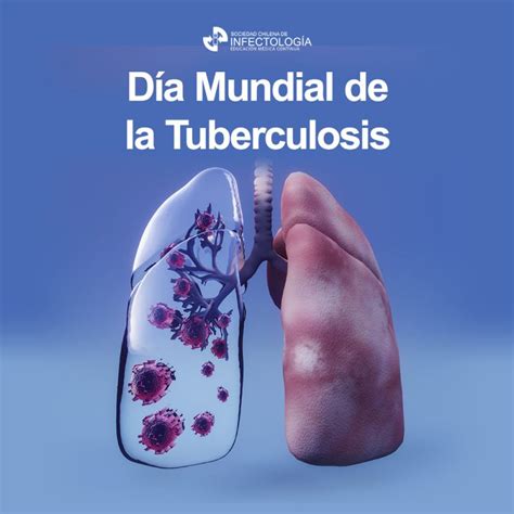 Día Mundial De La Tuberculosis Sochinf