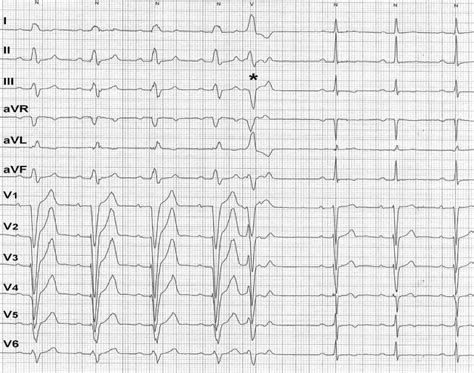 Intermittent Left Bundle Branch Block What Is The Mechanism