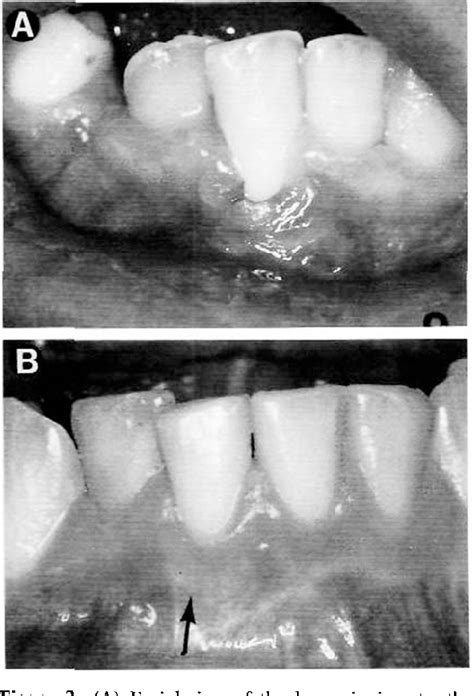 Figure From Mucogingival Considerations In Orthodontic Treatment