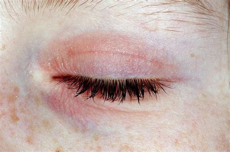 Eczema On The Eyelid Photograph By Dr P Marazzi Science Photo Library