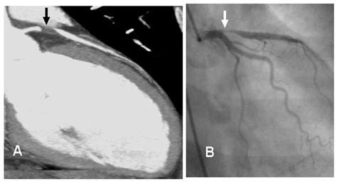 Life Free Full Text Cardiac Imaging In Women With Ischemic Heart