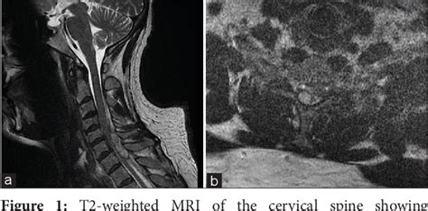 Figure From Spontaneous Cervical Epidural Hematoma Insight Into This