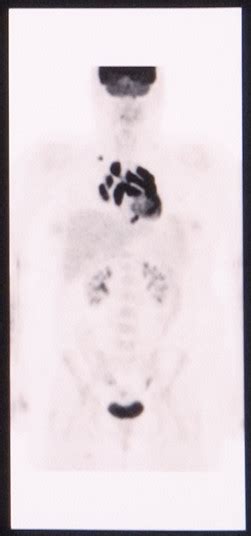 PET/CT showing extensive hypermetabolic mediastinal adenopathy ...