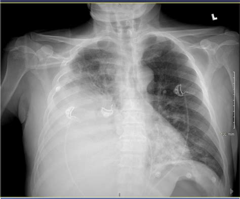 Chest Xray Bilateral Pneumonia And Large Right Pleural Effusion