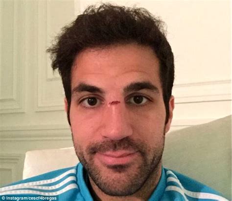 Chelsea Midfielder Cesc Fabregas Wears Protective Face Mask Against Qpr