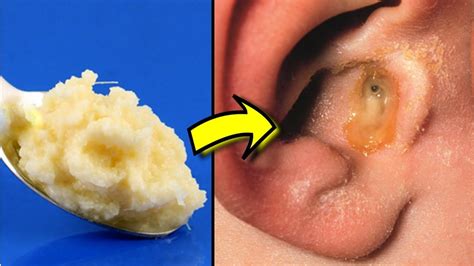 How To Cure Ear Infection Naturally At Home 6 Home Remedies For Ear