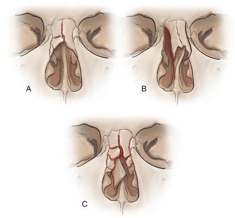 Nasal Fracture - Clinical Tree