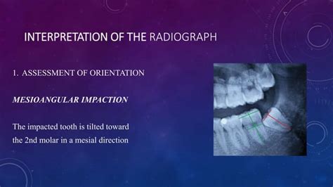 Radiographic Assessment Of Impacted Teeth Pptx